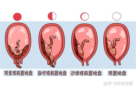 前置胎盤原因|前置胎盘